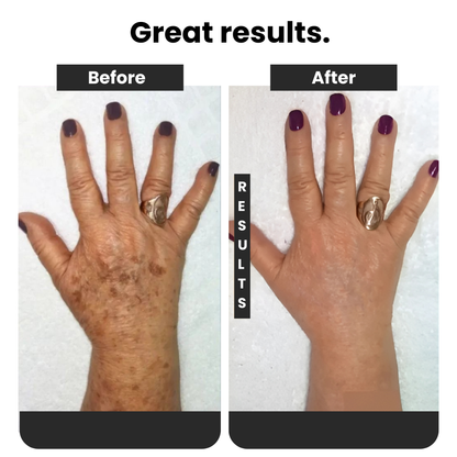 Dark Spot Remover Spray 577